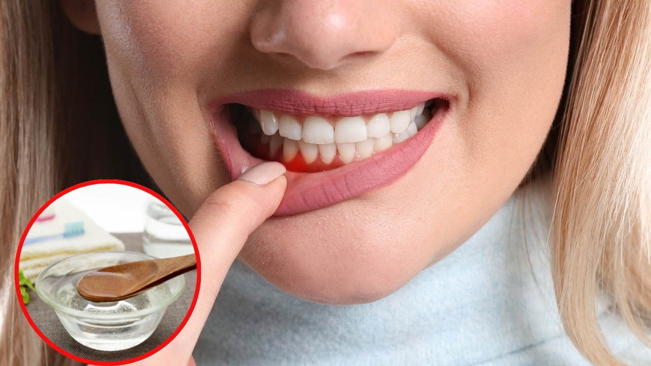 Bleeding Gums: చిగుళ్ల నుంచి రక్తం కారుతోందా ? ఇలా చేస్తే సమస్య దూరం