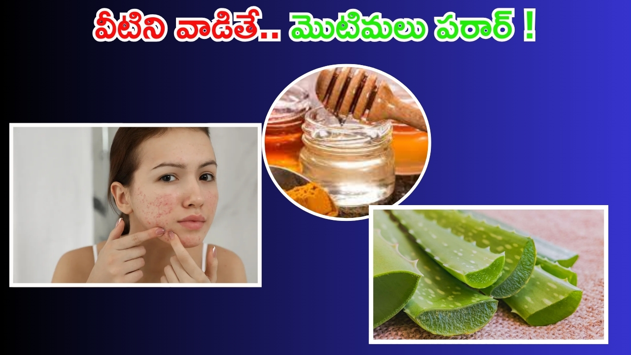 Pimple Problem: వీటితో మొటిమలకు చెక్ పెట్టండిలా !