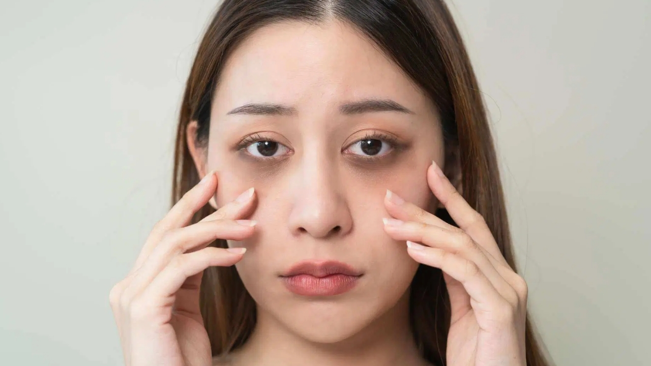 Dark Circles: డార్క్ సర్కిల్స్ తగ్గించే మార్గాలివే!